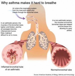 Asthma Therapy